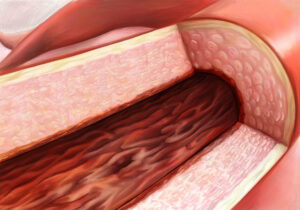 Blood vessel of a person with PAH